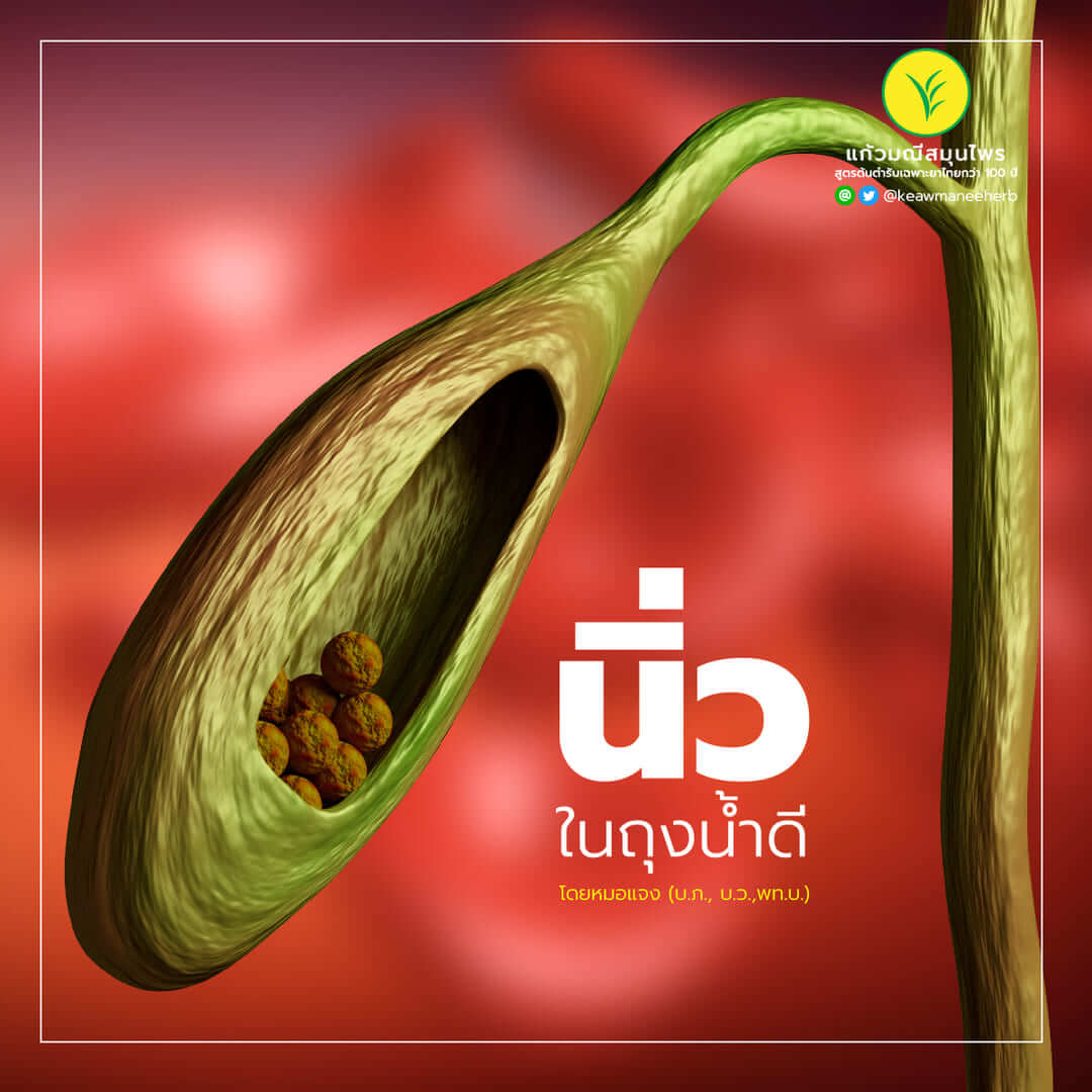 นิ่วในถุงน้ำดี โดยหมอแจง (บ.ภ., บ.ว.,พท.บ.)